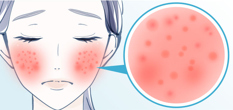 炎症による赤み