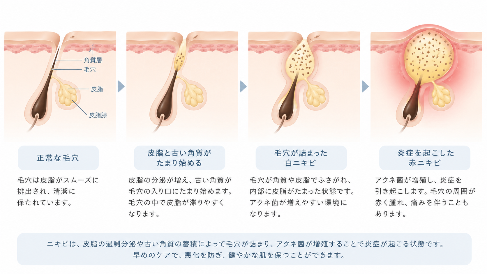 毛穴の詰まりから赤ニキビへ進行する仕組み