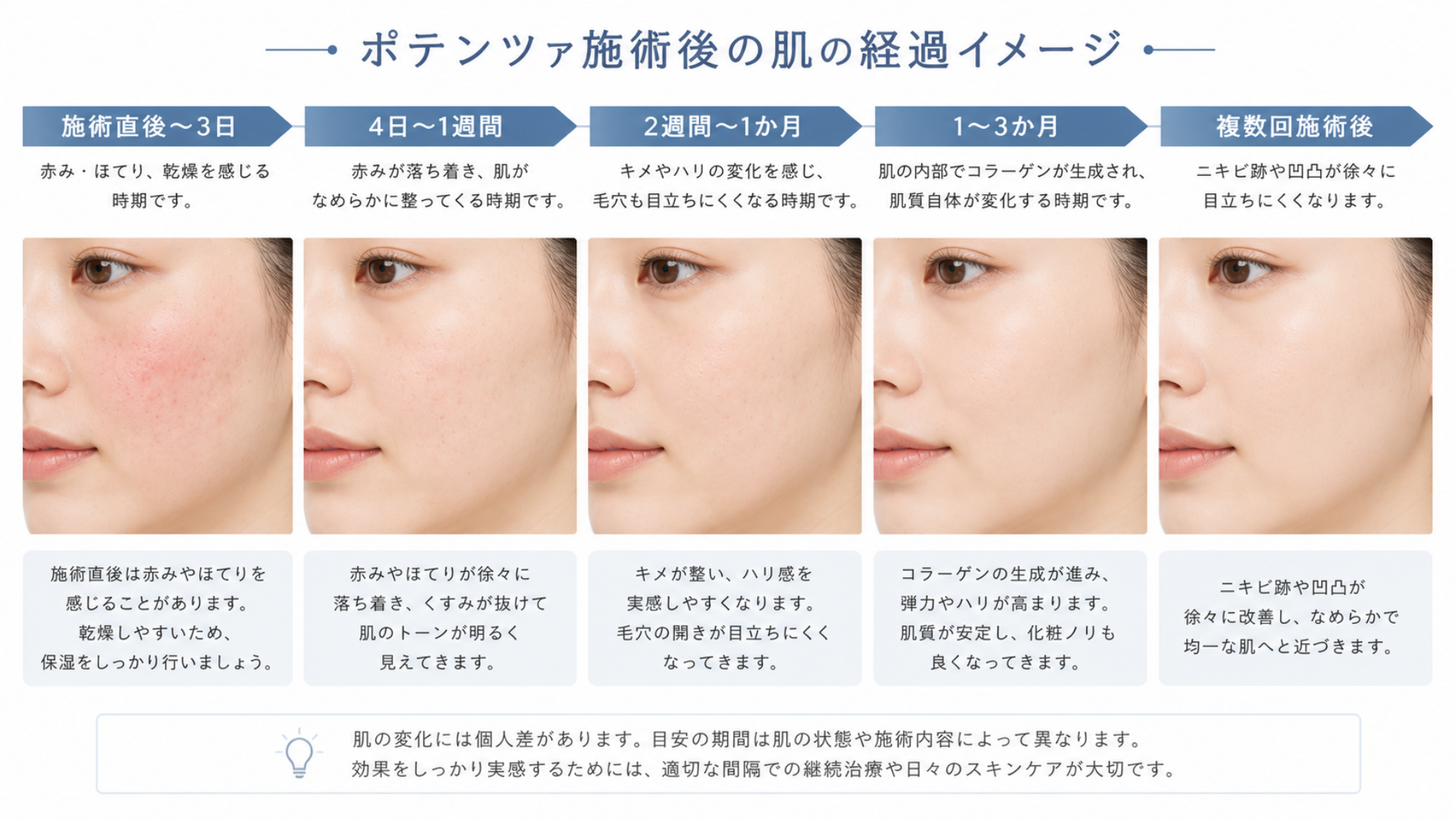 ポテンツァ施術直後から3か月後までの効果と肌の経過