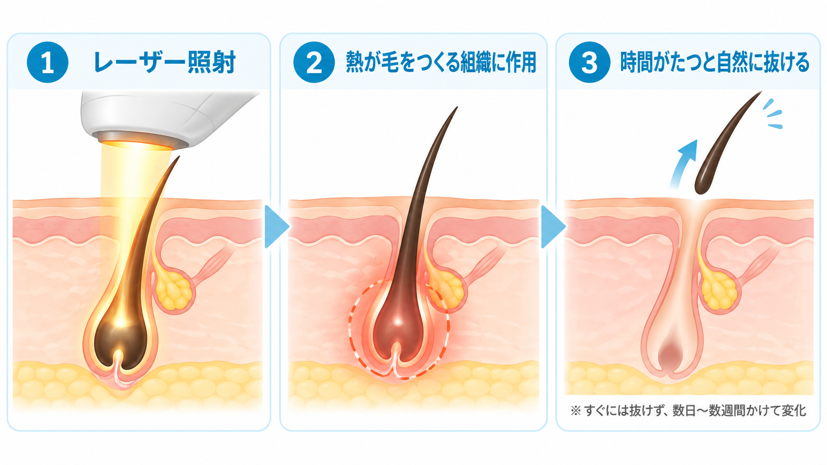 広島にある美容皮膚科　アークリシュ美容皮フ科の脱毛で毛が抜けるメカニズムを解説した画像です。